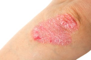 Bilde: Hva er psoriasis?