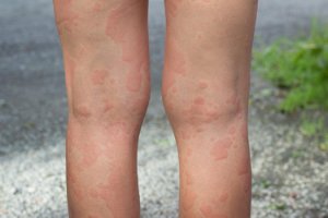 Bilde: Chronic urticaria (hives)